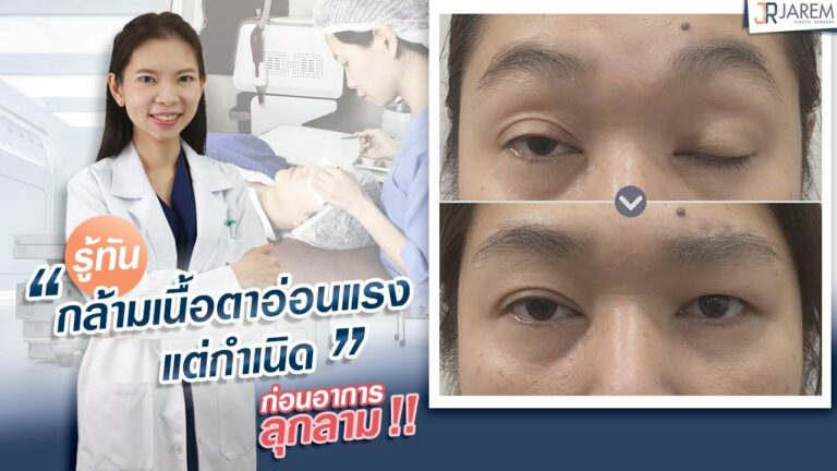 กล้ามเนื้อตาอ่อนแรงแต่กำเนิด คืออะไร?รักษาอย่างไร?