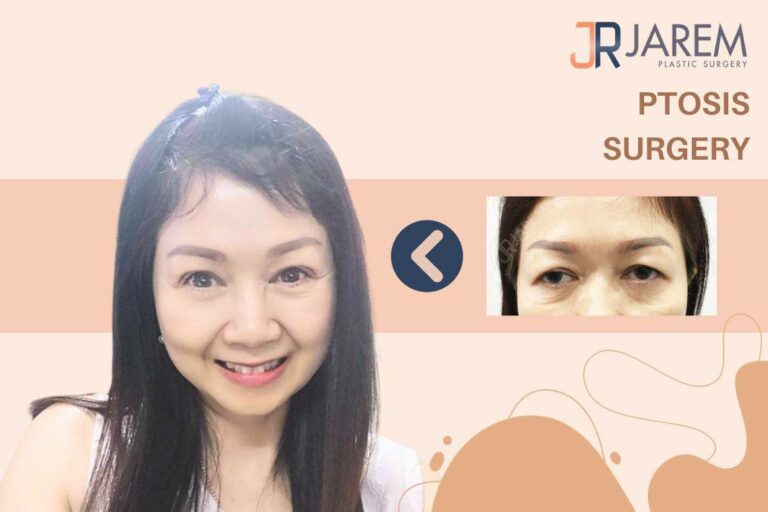 หนังตาหย่อนคล้อย