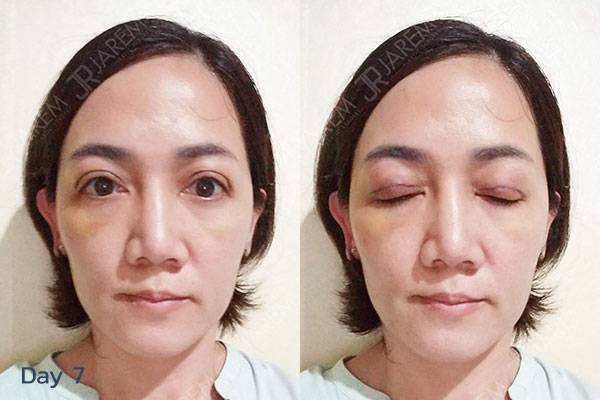 ศัลยกรรมตาสองชั้น