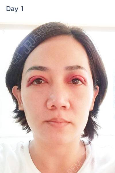 ทำตา2ชั้น