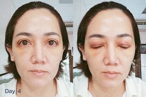 ศัลยกรรมตา