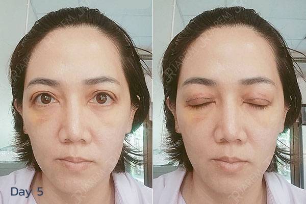 รีวิวทำตา