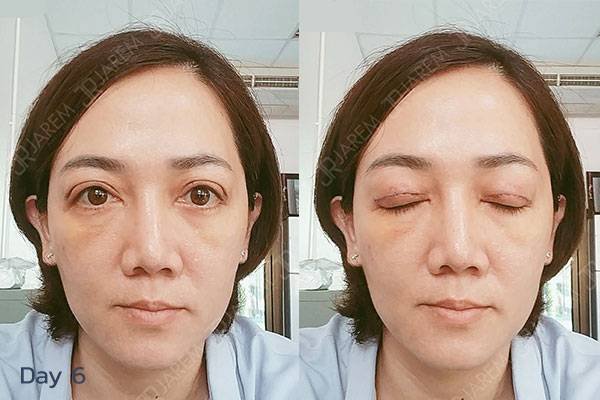 โรคกล้ามเนื้อตาอ่อนแรง