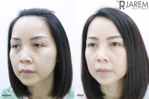 ทำตาเปลี่ยนชีวิต > เปลี่ยนตาง่วงนอนเป็นตาสวยสดใส หน้าดูเด็กลง