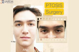 ผู้ชายทำตากันเยอะไหม ทำออกมาแล้วจะเป็นอย่างไร?