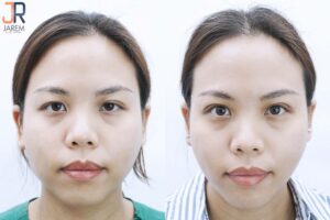 เปลี่ยนบุคลิกภาพครั้งใหม่ด้วยการรักษากล้ามเนื้อตาอ่อนแรง