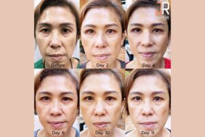 เนรมิตดวงตาสวยๆ ให้ใบหน้ากลับมาสดชื่นอีกครั้ง