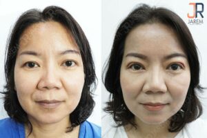 หนังตาตก กล้ามเนื้อตาอ่อนแรง ต้องผ่าตัดโดยจักษุแพทย์ผู้เชี่ยวชาญ