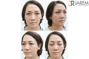 ทำตากรีดยาว แก้ไขกล้ามเนื้อตาอ่อนแรง ย้ายไขมันในตา