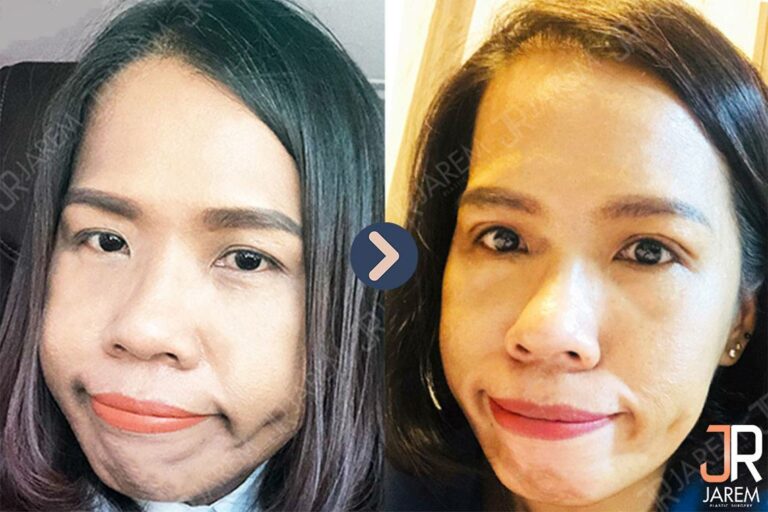 หนังตาตก แก้ไข