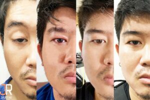 รักษาอาการลืมตาไม่สุดข้างเดียว ด้วยวิธีร้อยเอ็นเทียม