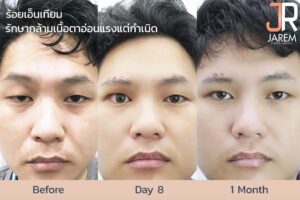 กล้ามเนื้อตาอ่อนแรงแต่กำเนิด รักษาได้ด้วยการร้อยเอ็นเทียม