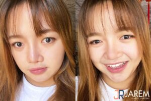 รีวิวแก้ตาตก เปลี่ยนภาพลักษณ์ใหม่ หลังรักษากล้ามเนื้อตาอ่อนแรงแต่กำเนิด