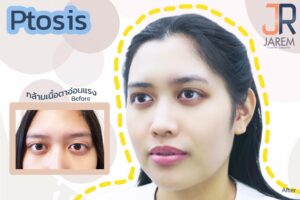 ปัญหาตาปรือ กล้ามเนื้อตายืดขยาย รักษาได้