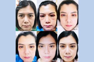 เก็บหนังตาส่วนเกิน จากภาวะหนังตาตก กล้ามเนื้อตาอ่อนแรง