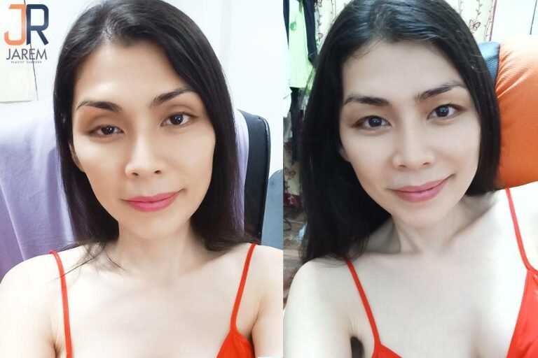เบ้าตาลึกโหล