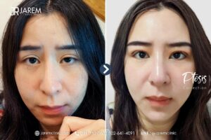 แก้ตาสองชั้น จักษุแพทย์ เลือกที่ไหน? แก้อย่างไรให้สวยและจบ