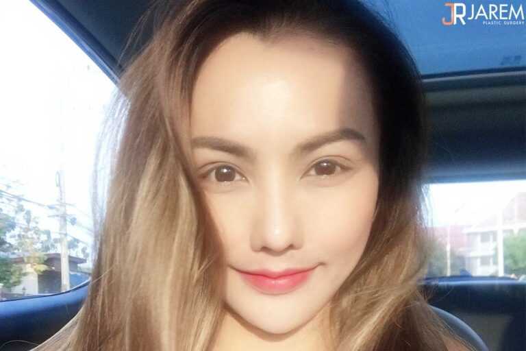 แก้ตา หลังทำตาสองชั้น