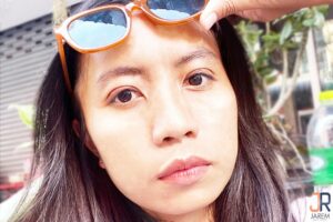 เติมไขมันตา แก้ไขปัญหาเบ้าตาลึก อันเนื่องมาจากกล้ามเนื้อตาอ่อนแรง