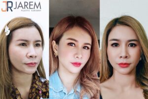 แก้ตา จาเรมคลินิก ครั้งที่ 3 ในชีวิต บอกเลยครั้งนี้ต้องสวยปัง!