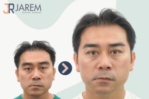 เก็บหนังตาส่วนเกิน จากภาวะกล้ามเนื้อตาอ่อนแรงที่เกิดขึ้นตามวัย