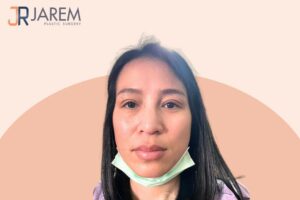 แก้ตาตก ผ่าตัด รักษากล้ามเนื้อตาอ่อนแรง