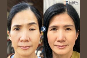 รีวิวร้อยเอ็นเทียม 1 ข้าง รักษากล้ามเนื้อตาอ่อนแรงแต่กำเนิด