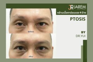 บอกลาหนังตาตก เบ้าตาลึก กล้ามเนื้อตาอ่อนแรง