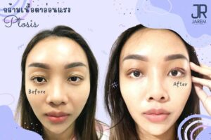 อาการตาล้า ตาปรือ ตาง่วงนอน ลืมตาไม่ขึ้น เกิดจากอะไร?