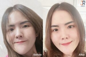 เปลี่ยนตาชั้นเดียวเป็นตาสองชั้นเล็กๆ ตามเทรนด์เกาหลี