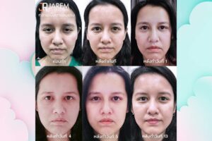 หน้าดูเหนื่อย โทรม ตาปรือมาก ใช่กล้ามเนื้อตาอ่อนแรงหรือไม่?