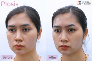 แก้ปัญหาชั้นตาหลายชั้น ตาปรือ ลืมตาได้ไม่เต็มที่