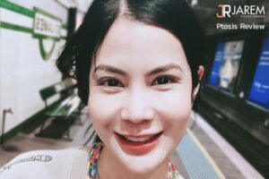 แก้ตาครั้งที่ 3 ปรับกล้ามเนื้อตา ช่วยให้ชั้นตาดูเท่ากัน