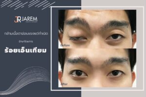 รีวิวร้อยเอ็นเทียม ใครอยากรักษากล้ามเนื้อตาอ่อนแรงต้องดู!