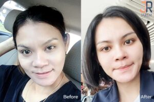 แก้ไขตาตกข้างเดียว ตาไม่เท่ากัน กล้ามเนื้อตาอ่อนแรง