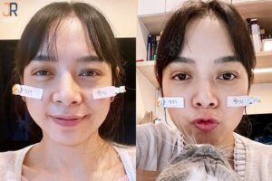 ไม่มีชั้นตา เบ้าตาลึก ตาปรือ ตาดูเศร้า รักษาอย่างไร?