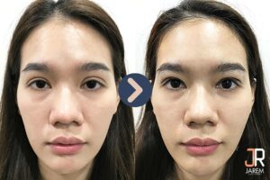 แก้ไขตาสองชั้น ชั้นตาหนา ชั้นตาไม่เท่ากัน คืนความมั่นใจให้ใบหน้า