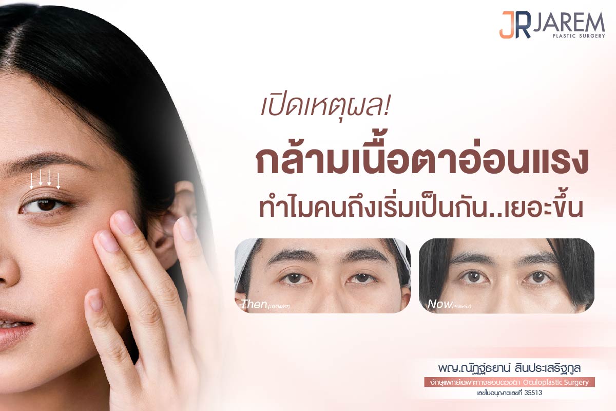 เปิดเหตุผล กล้ามเนื้อตาอ่อนแรง ทำไมคนถึงเริ่มเป็นกันเยอะขึ้น