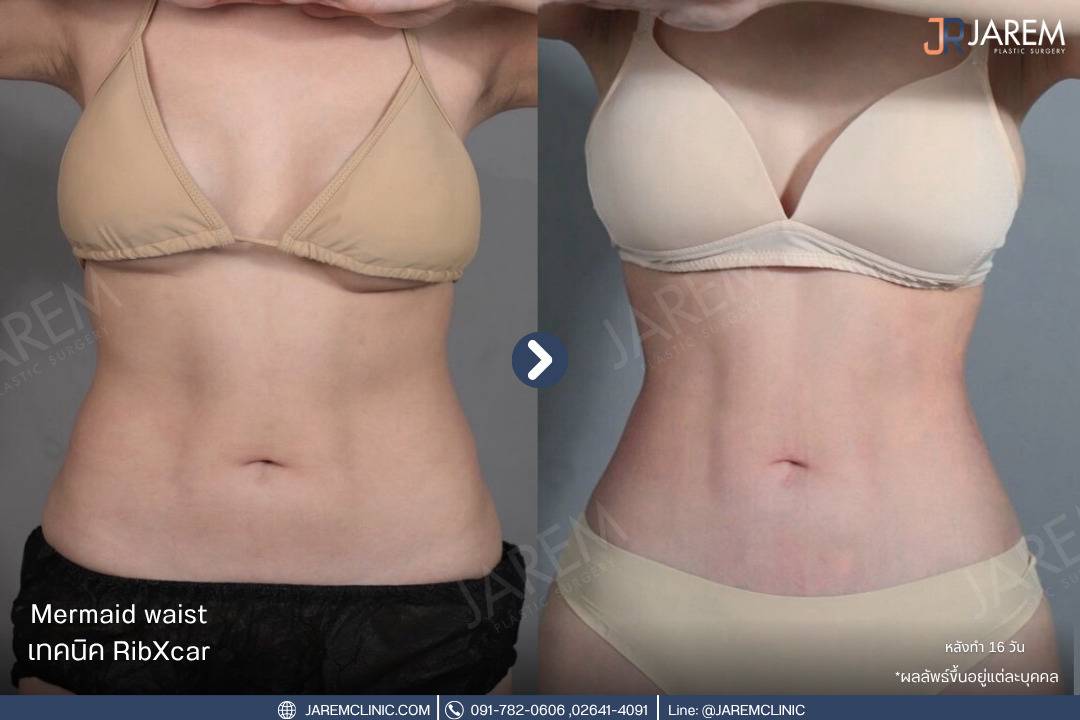 งอกระดูกซี่โครง,Ribxcar