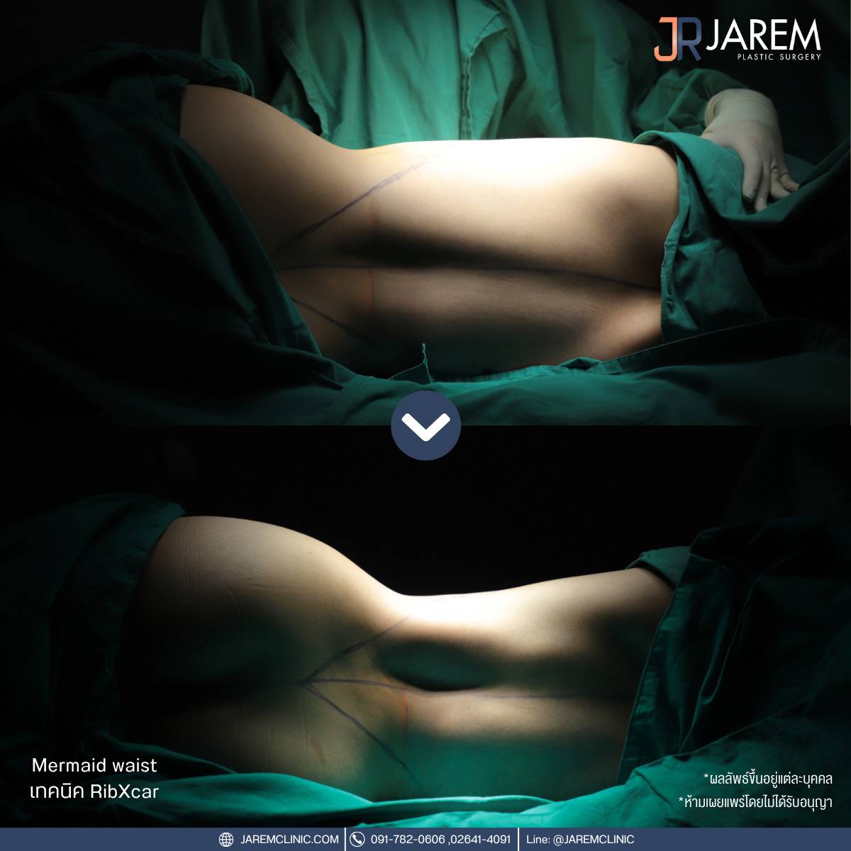 งอกระดูกซี่โครง,เอวคอด,เอวเอส,Ribxcar