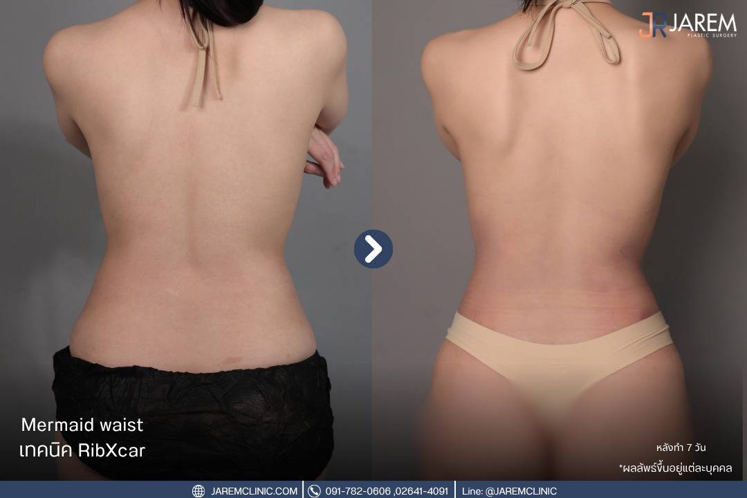 งอกระดูกซี่โครง,เอวคอด,เอวเอส,Ribxcar