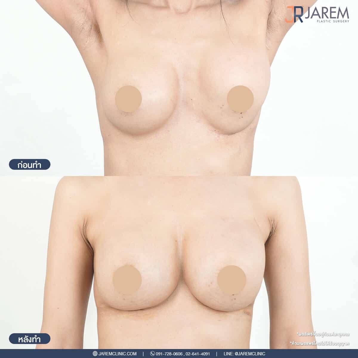ภาพก่อนและหลังแก้ไขหน้าอก | โดยคุณหมอหลุยส์ Jarem Clinic