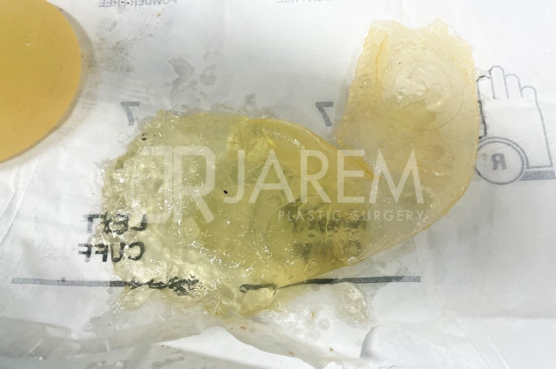 ซิลิโคนแตกรั่ว | แก้ไขหน้าอกโดยคุณหมอหลุยส์ Jarem Clinic