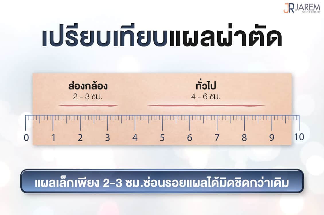 เปรียบเทียบแผลผ่าตัด เสริมหน้าอกส่องกล้อง | Jarem Clinic