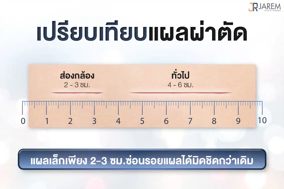 เปรียบเทียบแผลผ่าตัด เสริมหน้าอกส่องกล้อง | Jarem Clinic