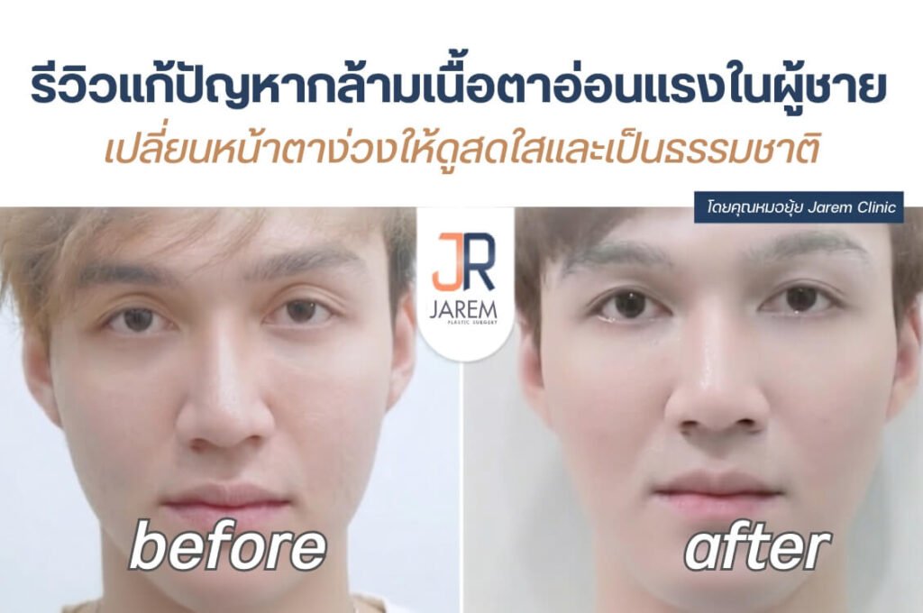 รีวิวแก้กล้ามเนื้อตาอ่อนแรงผู้ชาย เปลี่ยนหน้าง่วงให้สดใส เป็นธรรมชาติ โดยหมอยุ้ย | Jarem Clinic