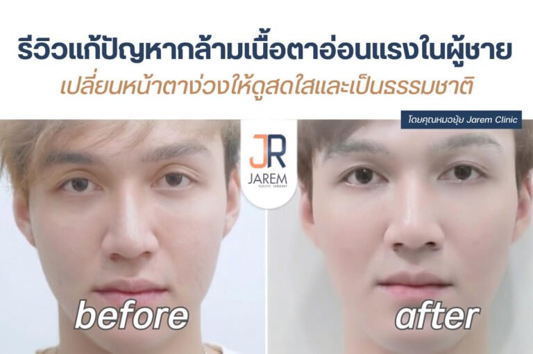 รีวิวแก้กล้ามเนื้อตาอ่อนแรงผู้ชาย เปลี่ยนหน้าง่วงให้สดใส เป็นธรรมชาติ โดยหมอยุ้ย | Jarem Clinic