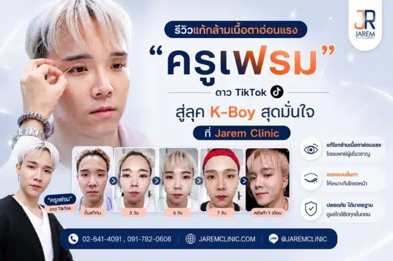 รีวิวแก้กล้ามเนื้อตาอ่อนแรงผู้ชาย สลัดลุค “ตาหมาหงอย” สู่ดวงตาสดใสสไตล์ K-Boy โดยคุณหมอยุ้ย จาเรมคลินิก | Jarem Clinic