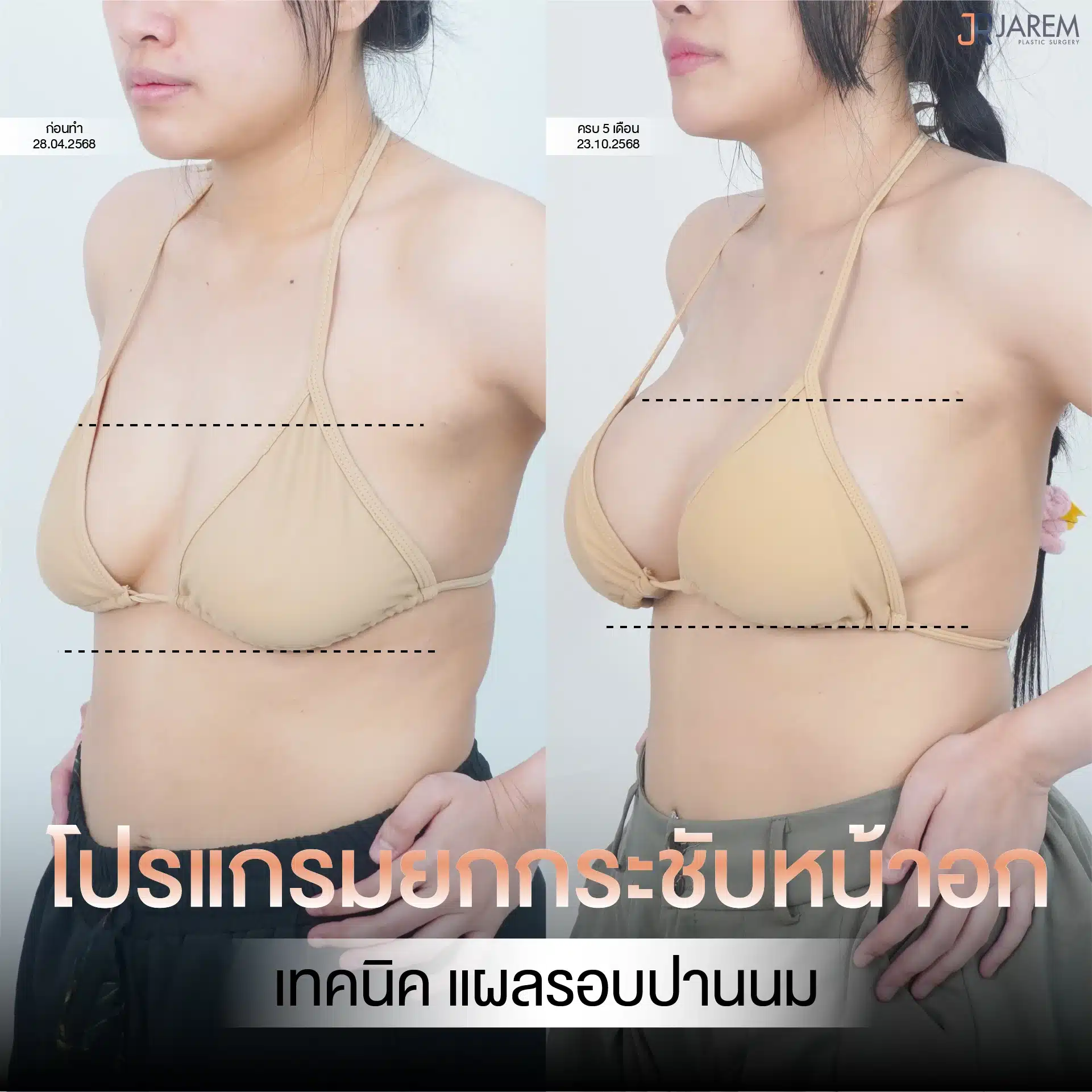Jarem Clinic โปรโมชัน ยกกระชับหน้าอก เทคนิคแผลรอบปานนม
