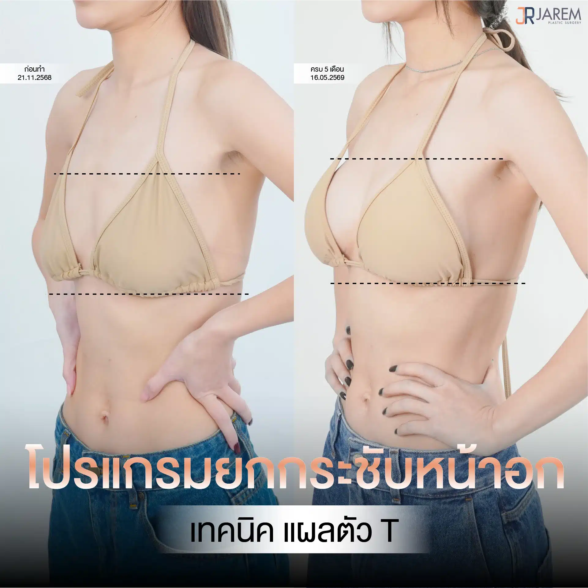 Jarem Clinic โปรโมชัน ยกกระชับหน้าอก เทคนิคแผล ตัว T เคส 2
